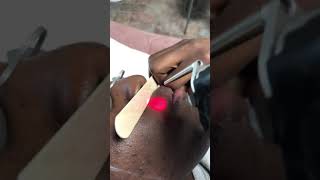 Laser hair removal , facial hair, On dark skin