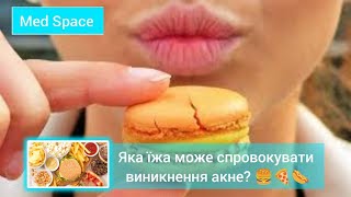 Яка їжа 🍔🌭🍕 може спровокувати акне? 😣