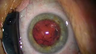 2024 05 22 153659 LAL+ denser cataract