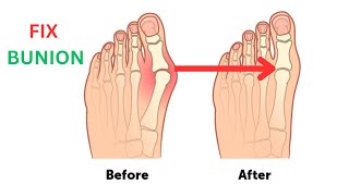 Fixing Bunions: Your Comprehensive Guide to Relieving Pain and Restoring Foot Health