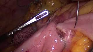 Laparoskopik sag tərəfli hemikolektomiya / Laparoscopic right hemicolectomy