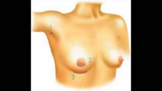 Los Angeles Breast Augmentation Scars and Incisions - Breast Implant Scars