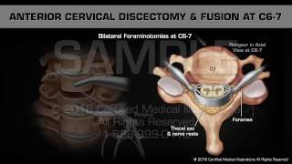 Передне-цервикальная дискэктомия и фиксация позвонков С6-7