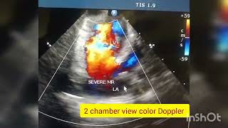 severe mitral regurgitation in a neonate