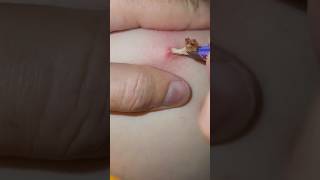 Blackheads Big