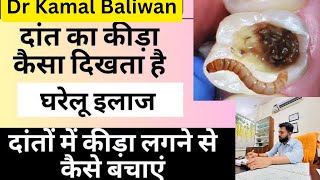 दांतों में कीड़ा लग गया है क्या करें||Danto Mai Cavity Ka Ilaaj|Dental Cavity Treatment|dant ka kida