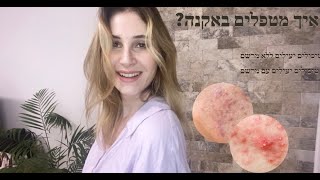 איך מטפלים באקנה?