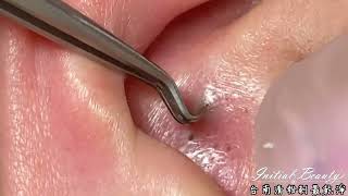 Ear Blackhead professional extraction  Full Video of blackhead removal on ear