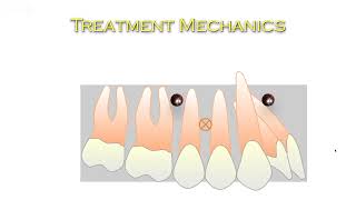 Orthodontic Treatment Mechanics