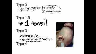 Chiari Malformation (Types 1-4)