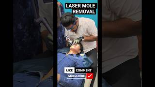 Laser permanent mole removal @DrArifMDDermatologist #shorts #mole #dermatology