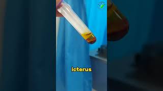 icterus | bilirubin | high bilirubin | icterus serum #medicallaboratory #bloodtest #medicallab