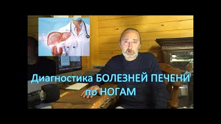 Диагностика БОЛЕЗНЕЙ ПЕЧЕНИ по НОГАМ. Первые Признаки больной Печени! ОЖИРЕНИЕ ПЕЧЕНИ / Фролов Ю.А.