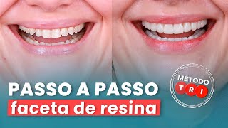 FACETA DE RESINA - Mylene e Renato