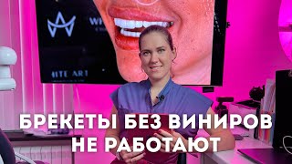 Брекеты без виниров не работают: почему после брекетов почти всегда требуется установка виниров?