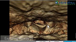 Airway Analysis