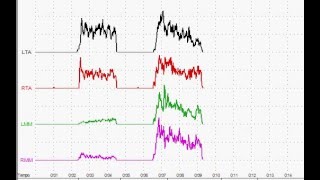 EMG comparativa dei muscoli masticatori Denti/Ortotico