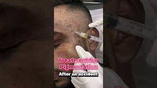 PRP Treatment for Pigmentation #skincenter #skincare #pigmentation  #prp