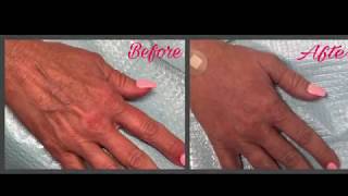 Dr. Damico injects Radiesse for hands