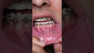 How to fix bad breath 🤢 #braces