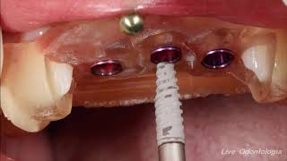 CIRURGIA GUIADA EM IMPLANTES DENTÁRIOS