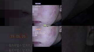 레이저박피 4회. 여드름 흉터치료 1년5개월간의 경과 #더레드피부과 #닥터개굴