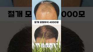 절개 모발이식 4000모 8개월 후기