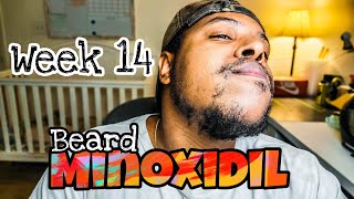 Growing Beard With Minoxidil Week 14