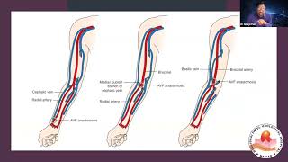 Dr  Abhijit Patel Types of Fistulas