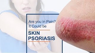 Skin Psoriasis: Causes, Symptoms & Treatment | Skin Care | Healthie Genie