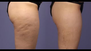 Effective, Natural Treatment For Cellulite