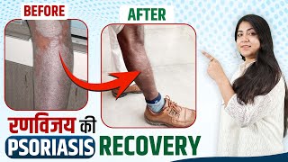 रणविजय ने होम्योपैथी के साथ पाई अपने सोरायसिस से मुक्ति | Psoriasis Testimonials