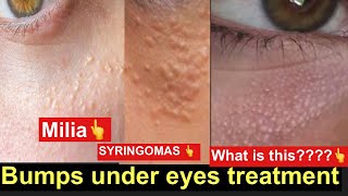 Bumps under eyes but not milia, not chicken skin under eye, | आँखो के नीचे सफ़ेद पीले dots |