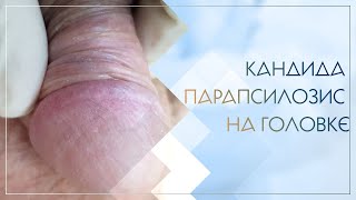 👦 Кандида парапсилозис на головке. Клинический случай №33