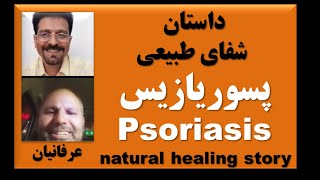 Psoriasis natural healing story/کی میگه پسوریازیس لا علاجه؟