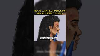 BEKAS LUKA RESTI MENGERAS MENJADI SEPERTI TANDUK #viral #viralvideo #viralshort #fypシ