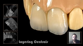 Layering central incisors (In Arabic)