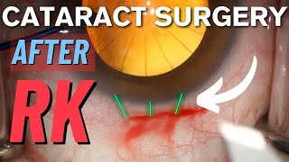 Cataract Surgery approach after Radial Keratotomy (RK) | Monofocal Lens