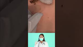 Dr.Nattacha, blackheads infected extraction.