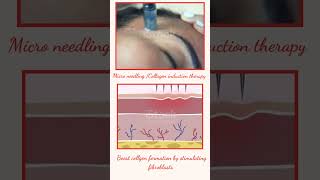 Scar treatment skin rejuvenation chispaarsh pune