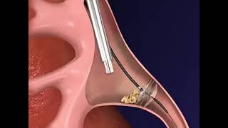 شاهد توضيح لعمليه ازاله الحصى من الكلى بالمنظار من طرف الاطباء.. طريقة فعالة