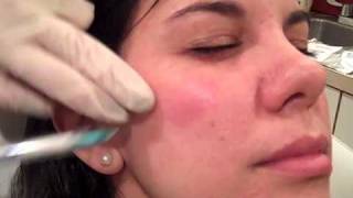 Radiesse Filler at Jardin Medical Spa in Philadelphia