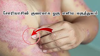 Skin Problem Solution in Tamil |தோல் நோய் குணமாக | Psoriasis Treatment in Tamil || காளாஞ்சகப்படை