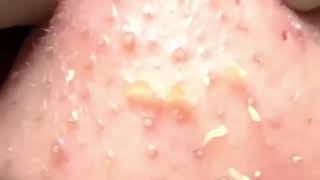 ピンセット,피지제거 Big Cystic Acne Blackheads