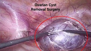 Ovarian Cyst Removal Surgery | Laparoscopic Bilateral Cystectomy with Mesh Placement