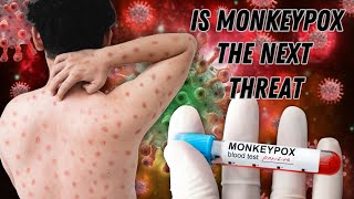 IS MONKEYPOX, THE NEXT THREAT?