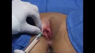 Labia Repair 2013