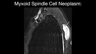 Myxoid Spindle Cell Neoplasm