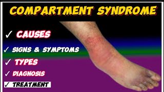 compartment syndrome