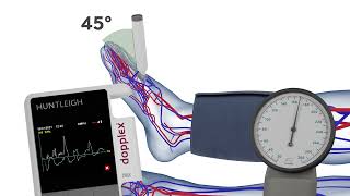 How to Measure the Systolic Pressure of the Dorsalis Pedis when Performing an ABPI